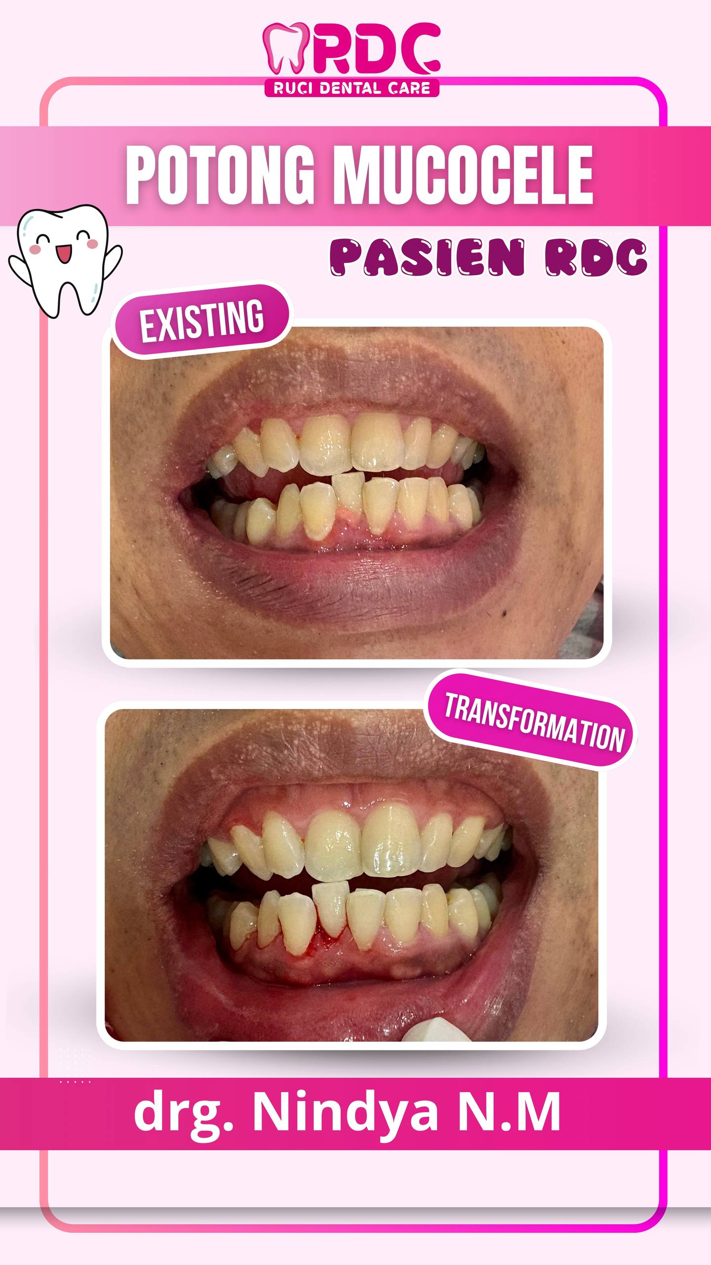 Mucocele
